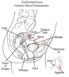 endometriosos